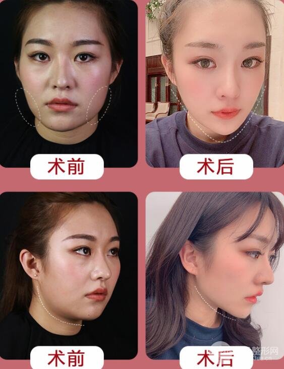 脸部吸脂果图