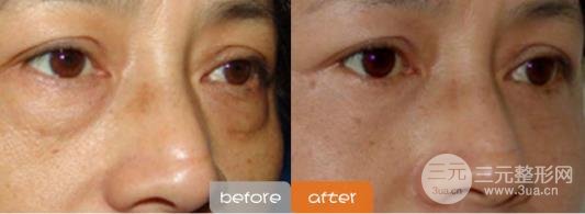 激光去眼袋的注意事项