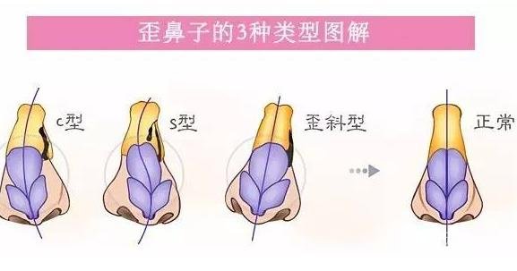 歪鼻矫正手术原理