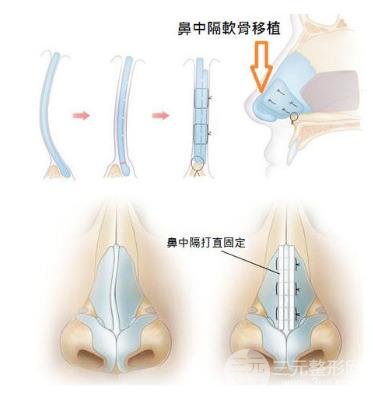 歪鼻矫正手术原理