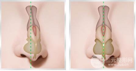 歪鼻手术的禁忌症