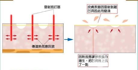 飞梭镭射原理介绍