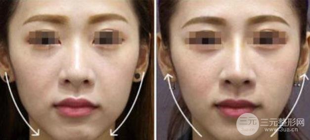 热拉提美容果原理