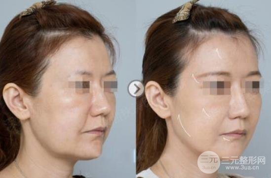 声刀美容的副作用