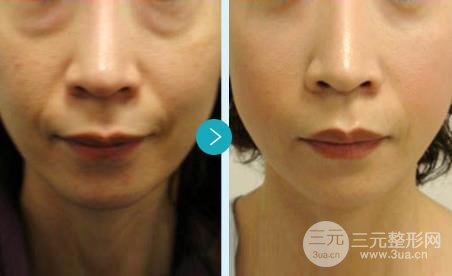 声刀美容的副作用