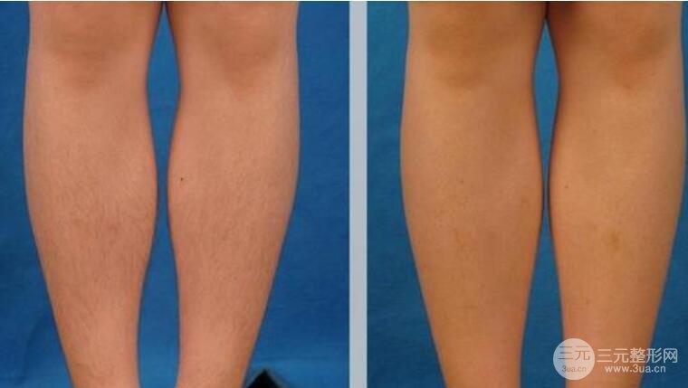 兰大二院美容科脱毛果图