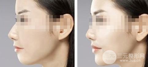 垫下巴后注意事项需谨记，不要因为这些细节而酿成大错!