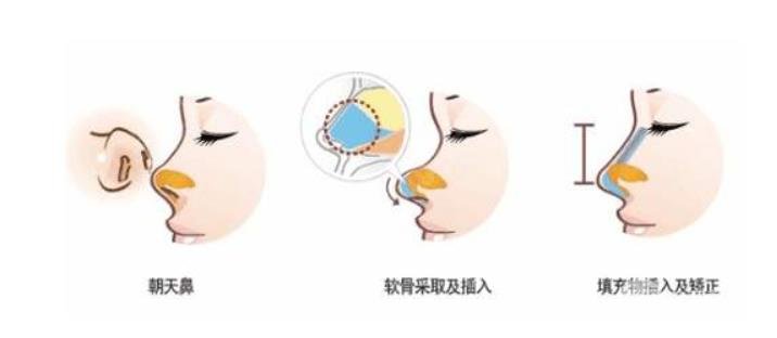朝天鼻矫正多少钱？这几点你必须要牢记~
