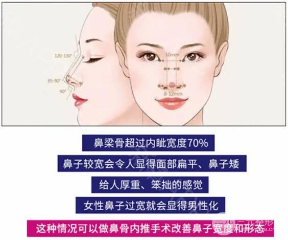 鼻骨缩小术适合哪些人