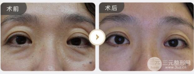 激光去眼袋果图