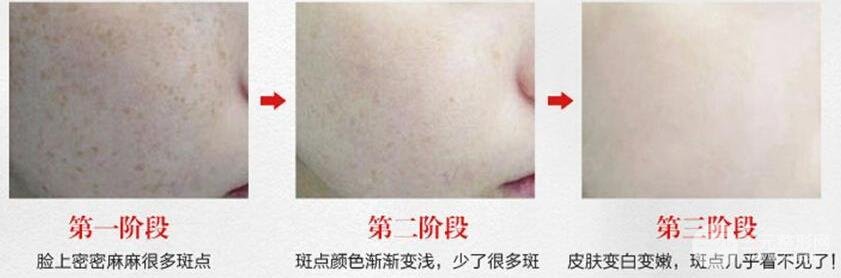 黄褐斑缓解方法