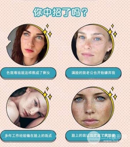 黄褐斑缓解方法