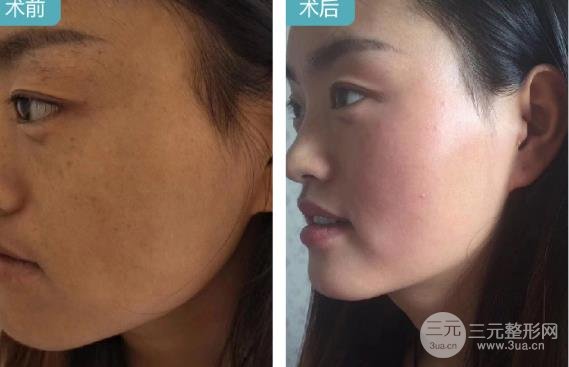 黄褐斑缓解方法的选择