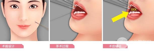 酒窝整形的方法