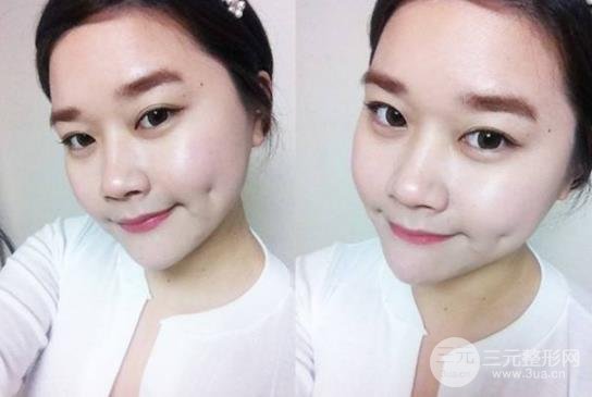 酒窝整形的方法