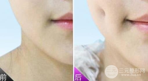 酒窝整形后的恢复时间