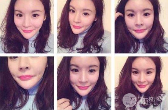 酒窝成形术的价格