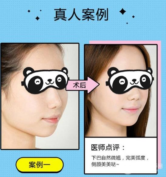 垫下巴手术后的注意事项