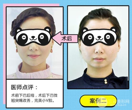 垫下巴手术后的注意事项