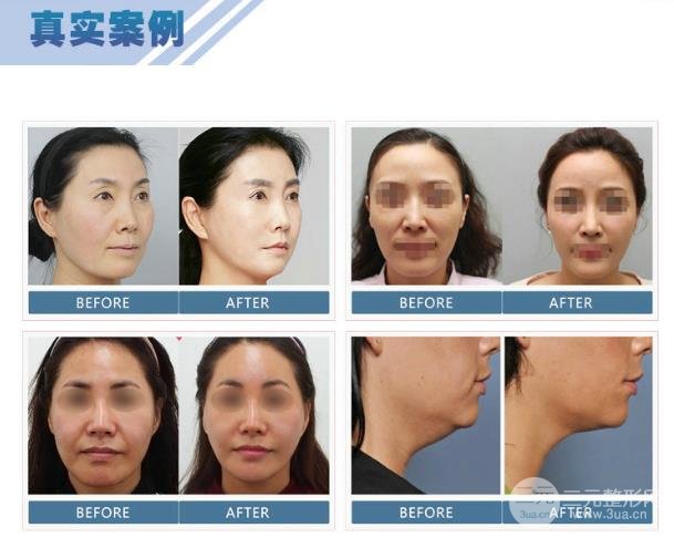热拉提美容维持的时间