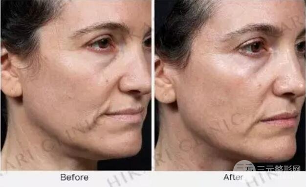 热玛吉只是一台仪器，医生的手法才是操作的灵魂!