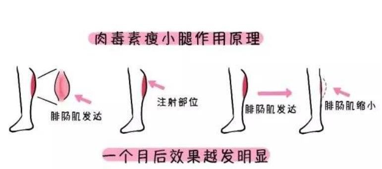 ****注射瘦腿的价格是多少？有哪些优势？