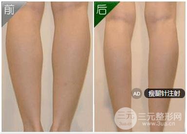 ****注射瘦腿的价格是多少？有哪些优势？
