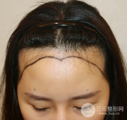 广西医科大学一附院植发价格