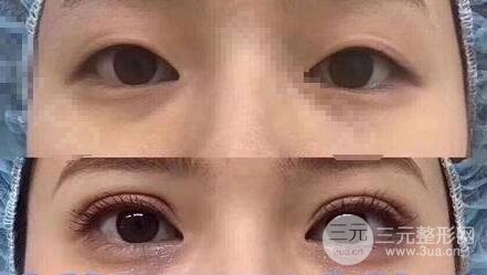 开眼角果好不好?对比一下简直惊艳~