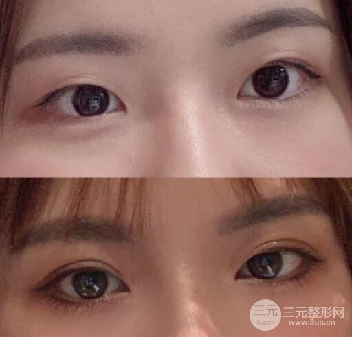 开眼角果好不好？对比一下简直惊艳~