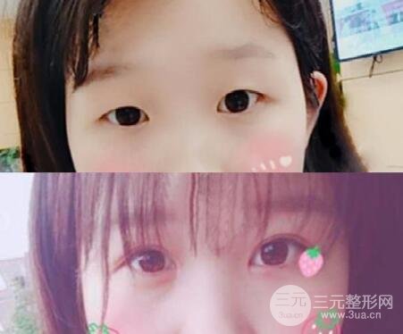 开眼角果好不好?对比一下简直惊艳~