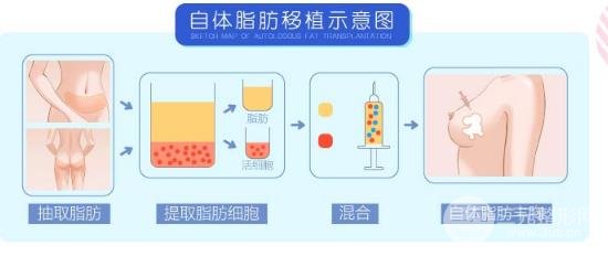 自体脂肪隆胸手术的价格