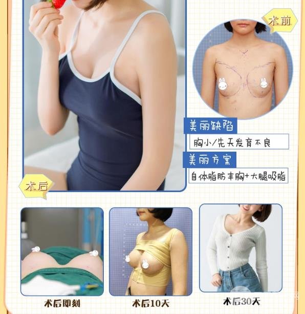 做自体脂肪隆胸手术的注意事项