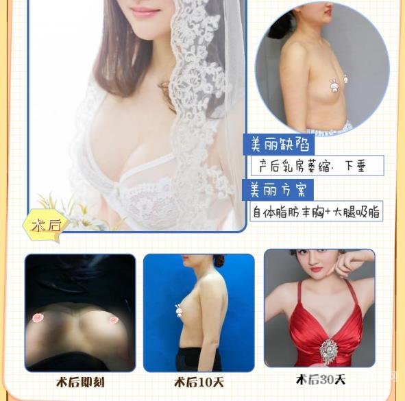 做自体脂肪隆胸手术的注意事项