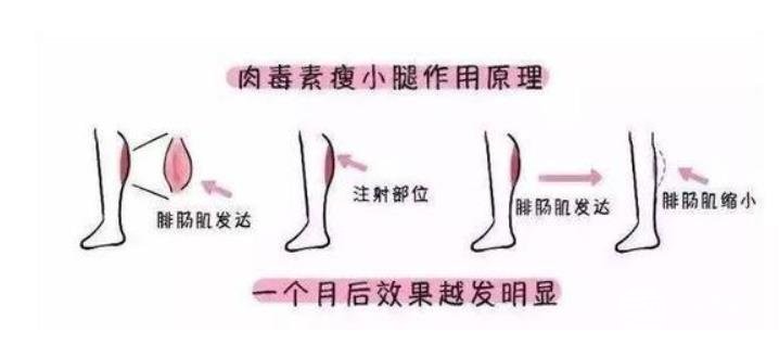 大腿肉注射瘦腿能打吗?注射瘦腿的原理请重新审视一下!