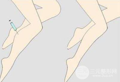 大腿肉注射瘦腿能打吗?注射瘦腿的原理请重新审视一下!