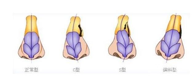 做取隆鼻假体修复术的补救措施，如何再次拥有美鼻