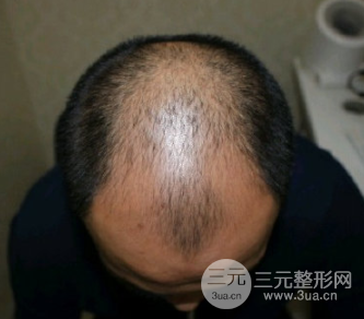 新乡市中心医院植发手术