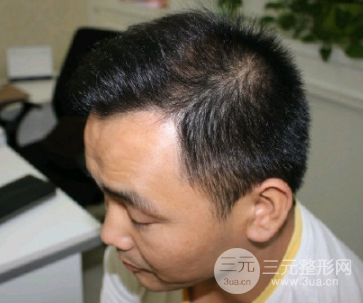 新乡市中心医院植发手术