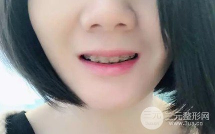 正畸牙齿后脸型变化图
