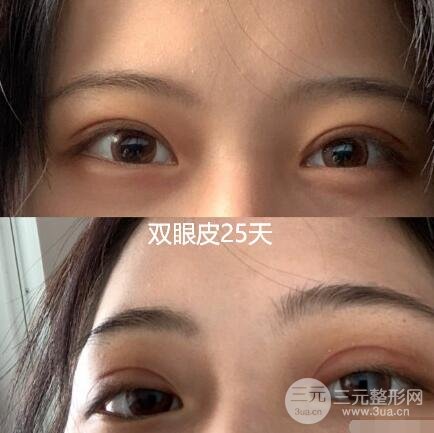 割双眼皮需要多少钱？猪猪女孩绝不认输~
