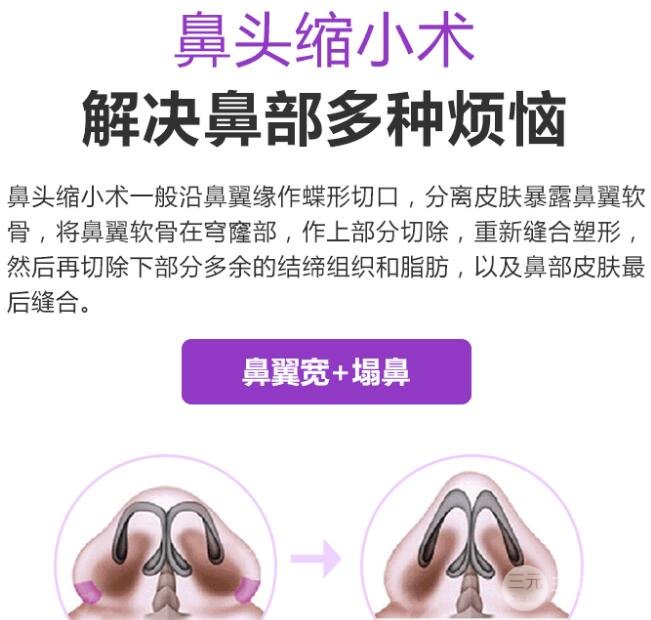 缩小鼻头多少钱?猪鼻子问题这样解决~