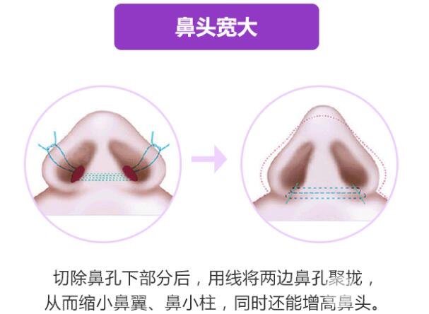 缩小鼻头多少钱?猪鼻子问题这样解决~