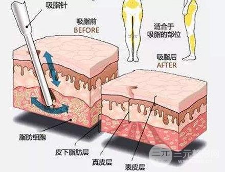 全身吸脂手术原理