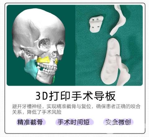 影响削骨手术价格的因素