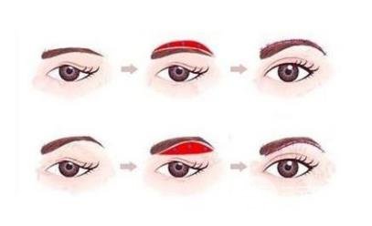 切眉术会留下疤痕吗?