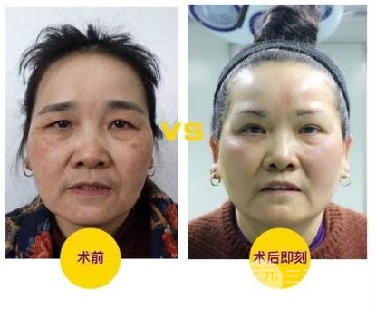 切眉术会留下疤痕吗?