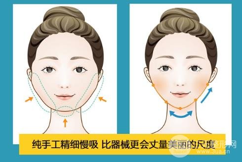 面部吸脂可以一直吸吗?