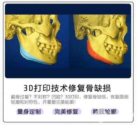 削骨瘦脸的价格
