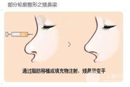 注射隆鼻术玻尿酸or自体脂肪,该如何选择?